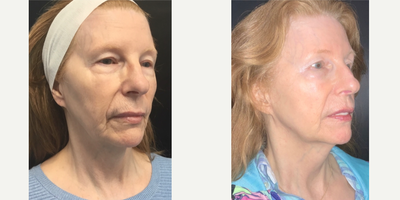 Case 5897 - 55-64 year old woman treated with NeoGen Plasma, Restylane, Lip Fillers, Dysport, Botox