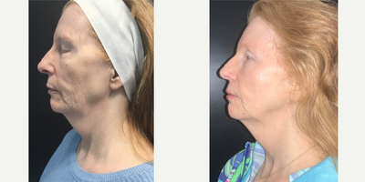 Case 5898 - 55-64 year old woman treated with NeoGen Plasma, Restylane, Lip Fillers, Dysport, Botox
