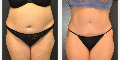 Case 590 - 52 year old woman treated with Tummy Tuck