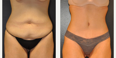 Case 591 - 32 year old woman treated with Tummy Tuck