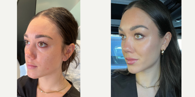 Case 5917 - 25-34 year old woman treated with Botox, Lip Fillers, Chin Filler