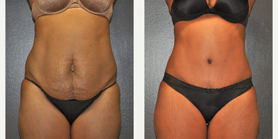 Case 592 - 25-34 year old woman treated with Tummy Tuck