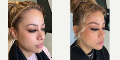 Case 5920 - 25-34 year old woman treated with Botox