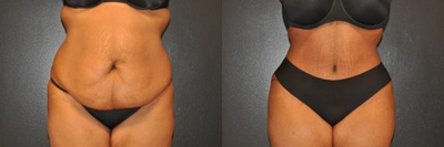 Case 593 - 34 year old woman treated with Tummy Tuck