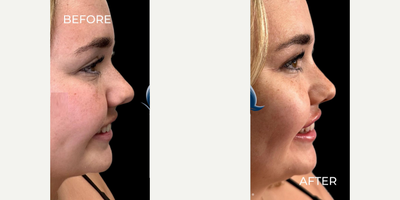 Case 5946 - Woman treated with Botox, Lip Fillers