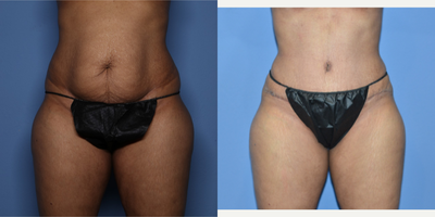 Case 595 - 35-44 year old woman treated with Tummy Tuck