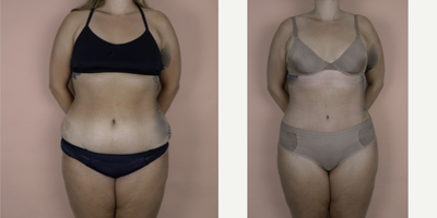 Case 596 - 18-24 year old woman treated with Tummy Tuck