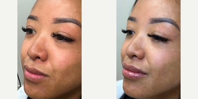 Case 5969 - Woman treated with Botox