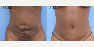 Case 597 - Woman treated with Tummy Tuck