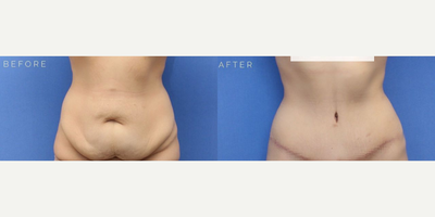 Case 598 - Woman treated with Tummy Tuck