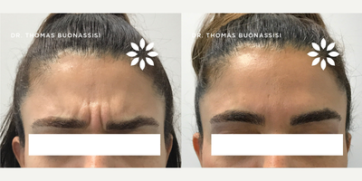 Case 5988 - 35-44 year old woman treated with Botox