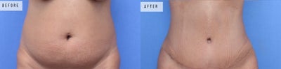 Case: 6 - before and after photo of Woman treated with Tummy Tuck, Liposuction by Jason Altman, MD