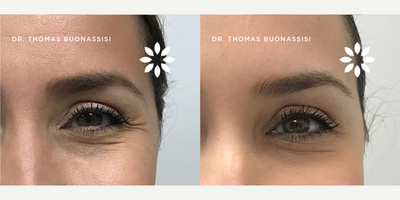 Case 6009 - 35-44 year old woman treated with Botox