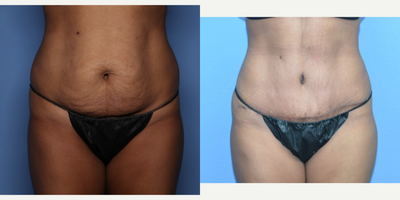 Case 601 - 35-44 year old woman treated with Tummy Tuck