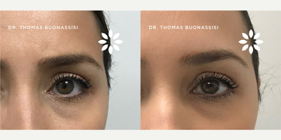 Case 6010 - 35-44 year old woman treated with Botox Non-Surgical Brow Lift
