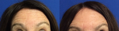 Case 6029 - 35-44 year old woman treated with Botox