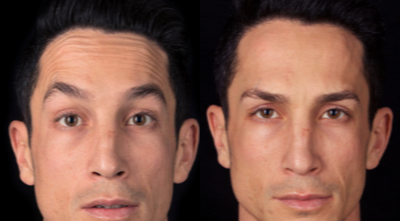 Case 6034 - 25-34 year old man treated with Botox