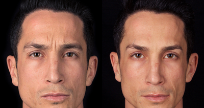 Case 6035 - 25-34 year old man treated with Botox
