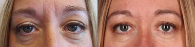 Case 6049 - 35-44 year old woman treated with Botox for between the Eyes (11's).