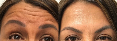 Case 6050 - 45-54 year old woman treated with Botox in the Forehead