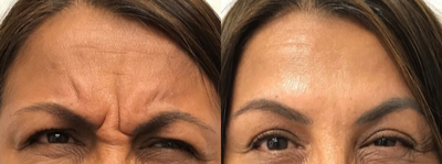 Case 6051 - 45-54 year old man treated with Botox in the Glabella