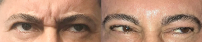 Case 6052 - 45-54 year old man treated with Botox in Glabella