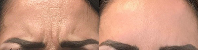 Case 6053 - 35-44 year old woman treated with Botox in Glabella