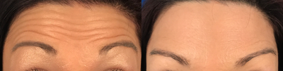 Case 6054 - 35-44 year old woman treated with Botox in Forehead