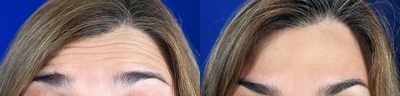 Case 6055 - 35-44 year old woman treated with Botox