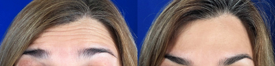 Case 6079 - 35-44 year old woman treated with Botox