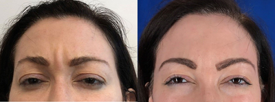 Case 6090 - 45-54 year old woman treated with Botox