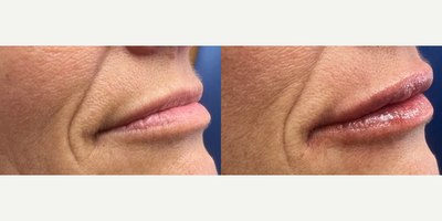 Case 6091 - Woman treated with Restylane, Botox
