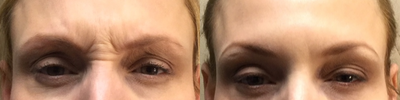 Case 6095 - 35-44 year old woman treated with Botox