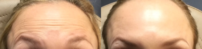 Case 6096 - 35-44 year old woman treated with Botox