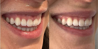 Case 6097 - 25-34 year old woman treated with Botox for gummy smile