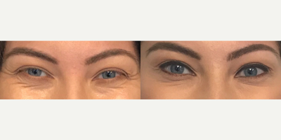 Case 6108 - Woman treated with Botox