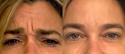 Case 6109 - Woman treated with Botox