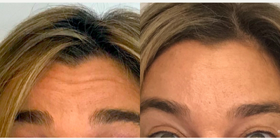 Case 6110 - Woman treated with Botox