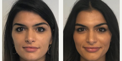 Case 6111 - Woman treated with Botox