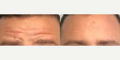 Case 6112 - Man treated with Botox
