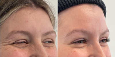 Case 6115 - 25-34 year old woman treated with Botox