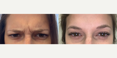 Case 6118 - 25-34 year old woman treated with Botox