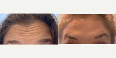 Case 6119 - 25-34 year old woman treated with Botox