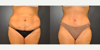 Case 612 - 28 year old woman treated with Tummy Tuck