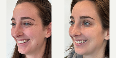 Case 6124 - 25-34 year old woman treated with Botox