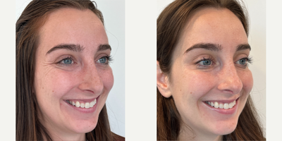 Case 6125 - 25-34 year old woman treated with Botox