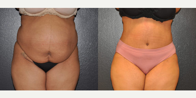 Case 613 - 42 year old woman treated with Tummy Tuck