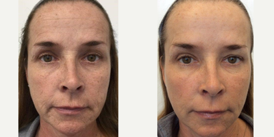 Case 6133 - 45-54 year old woman treated with Botox