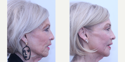 Case 6135 - 65-74 year old woman treated with Eyelid Surgery, Halo Laser, Botox