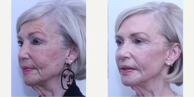 Case 6136 - 65-74 year old woman treated with Eyelid Surgery, Halo Laser, Botox
